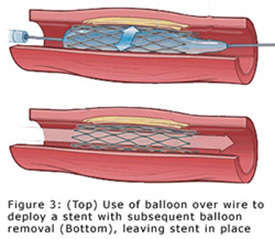 Coronary Angioplasty / Stent